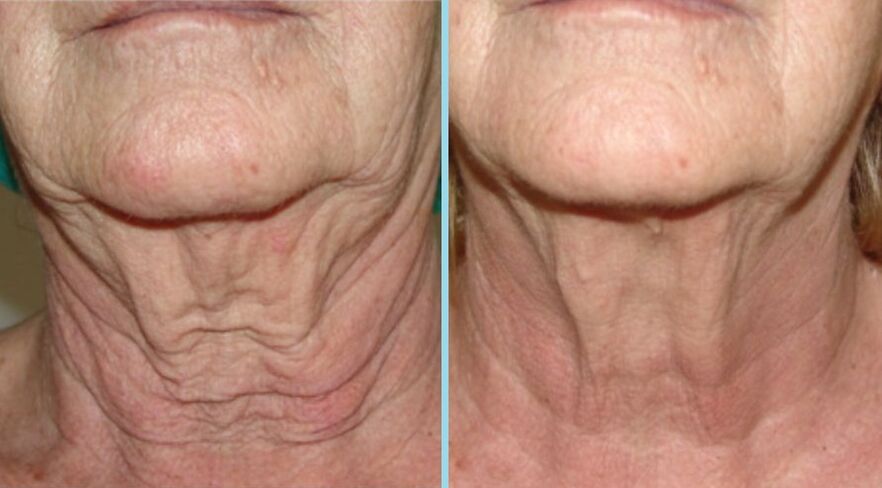 neck before and after fractional rejuvenation