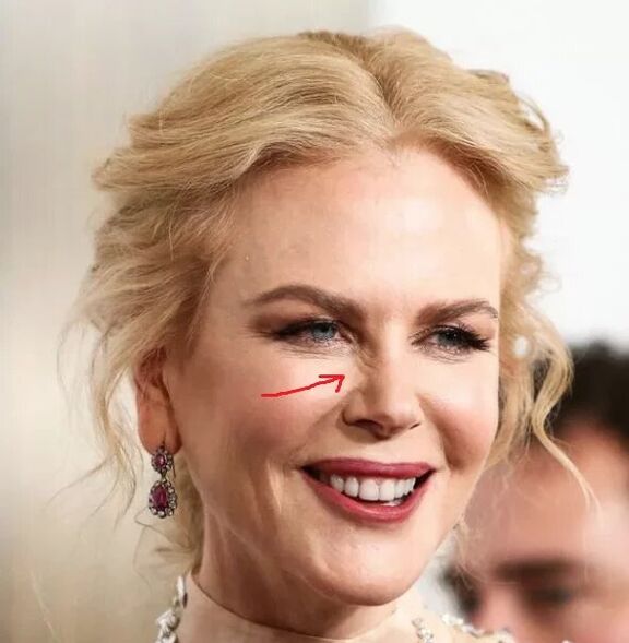 Alternative to Botox