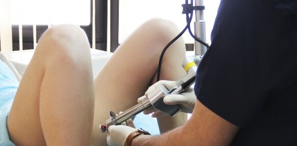 Laser removal of condylomas.