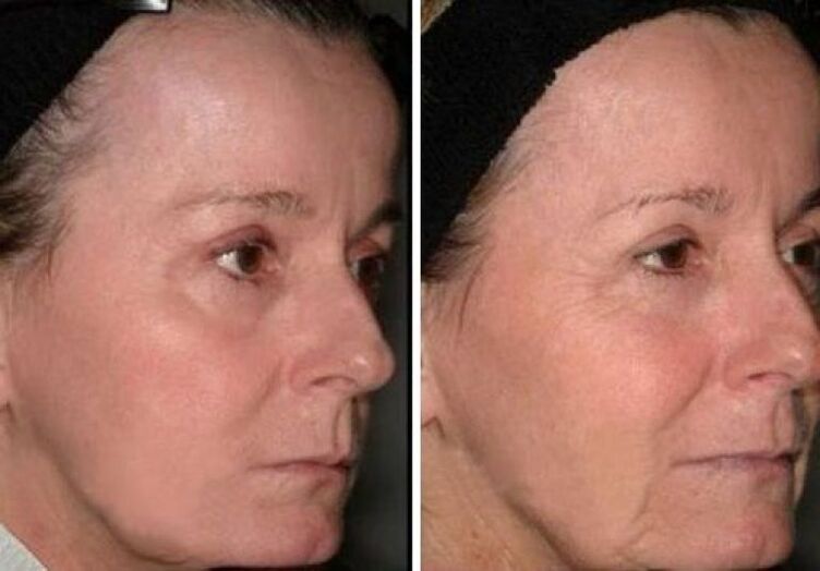 before and after laser skin rejuvenation photo 2